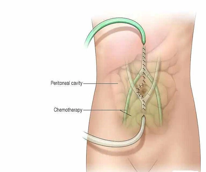 HIPEC Surgery Oncology in Thane